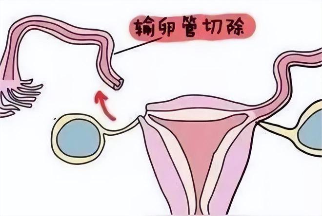 男性不育