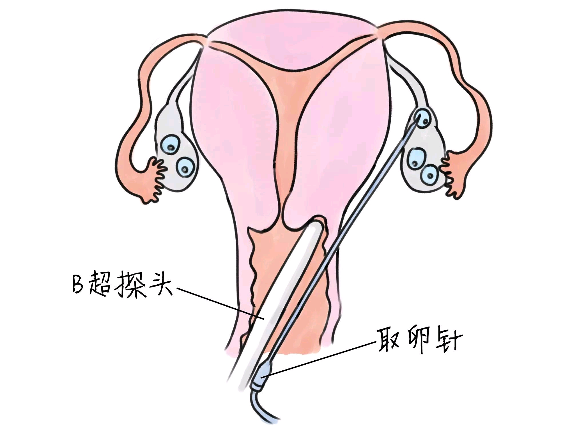 着床出血