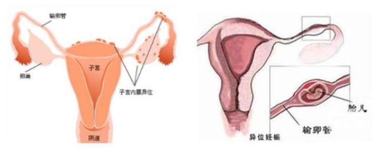 着床出血