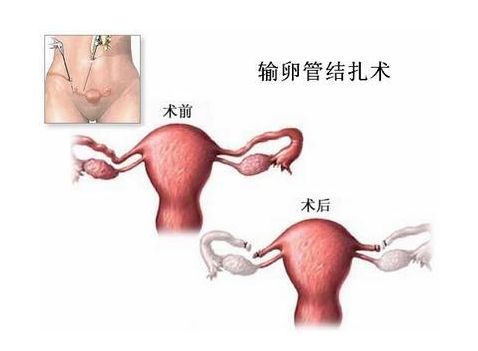 着床出血